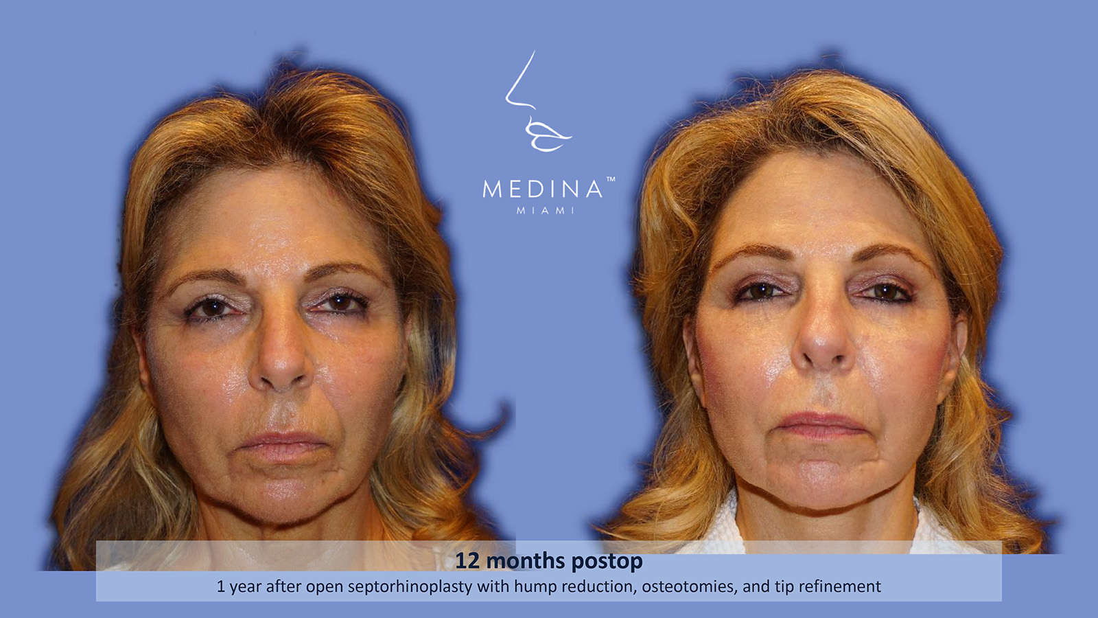 Case--4862 | Before and After Rhinoplasty