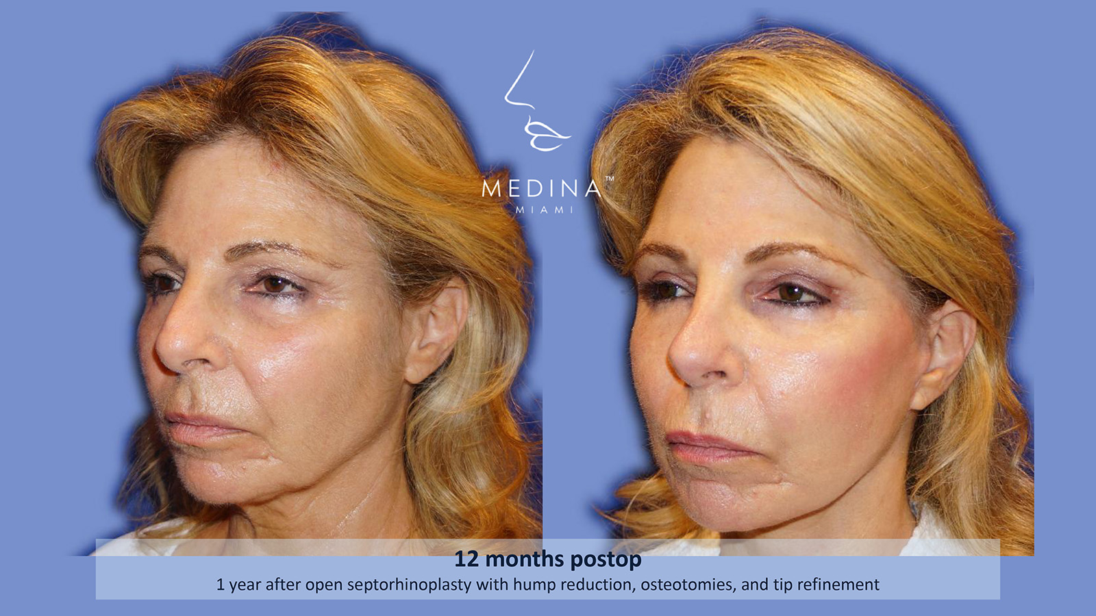 Case--4862 | Before and After Rhinoplasty 2