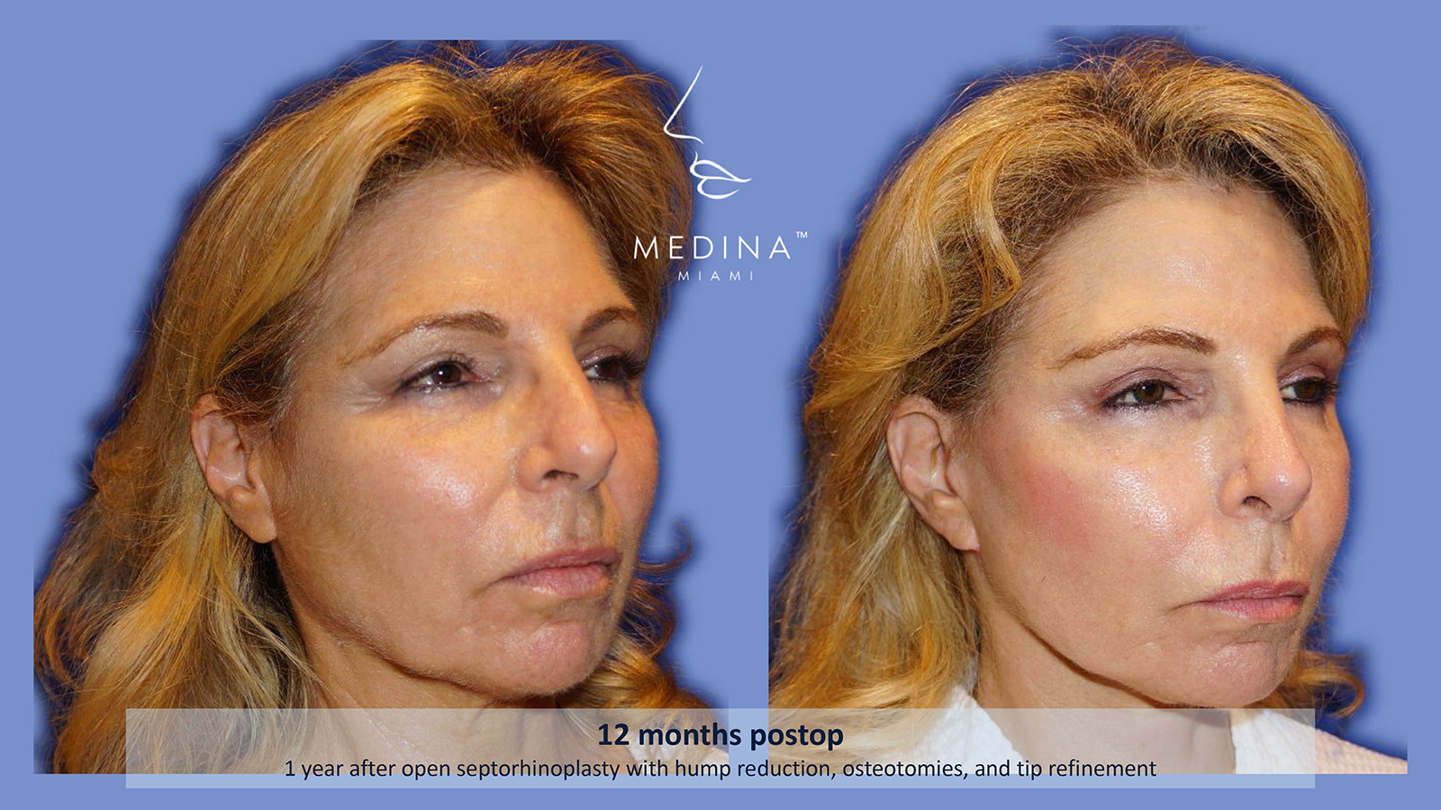 Case--4862 | Before and After Rhinoplasty 3