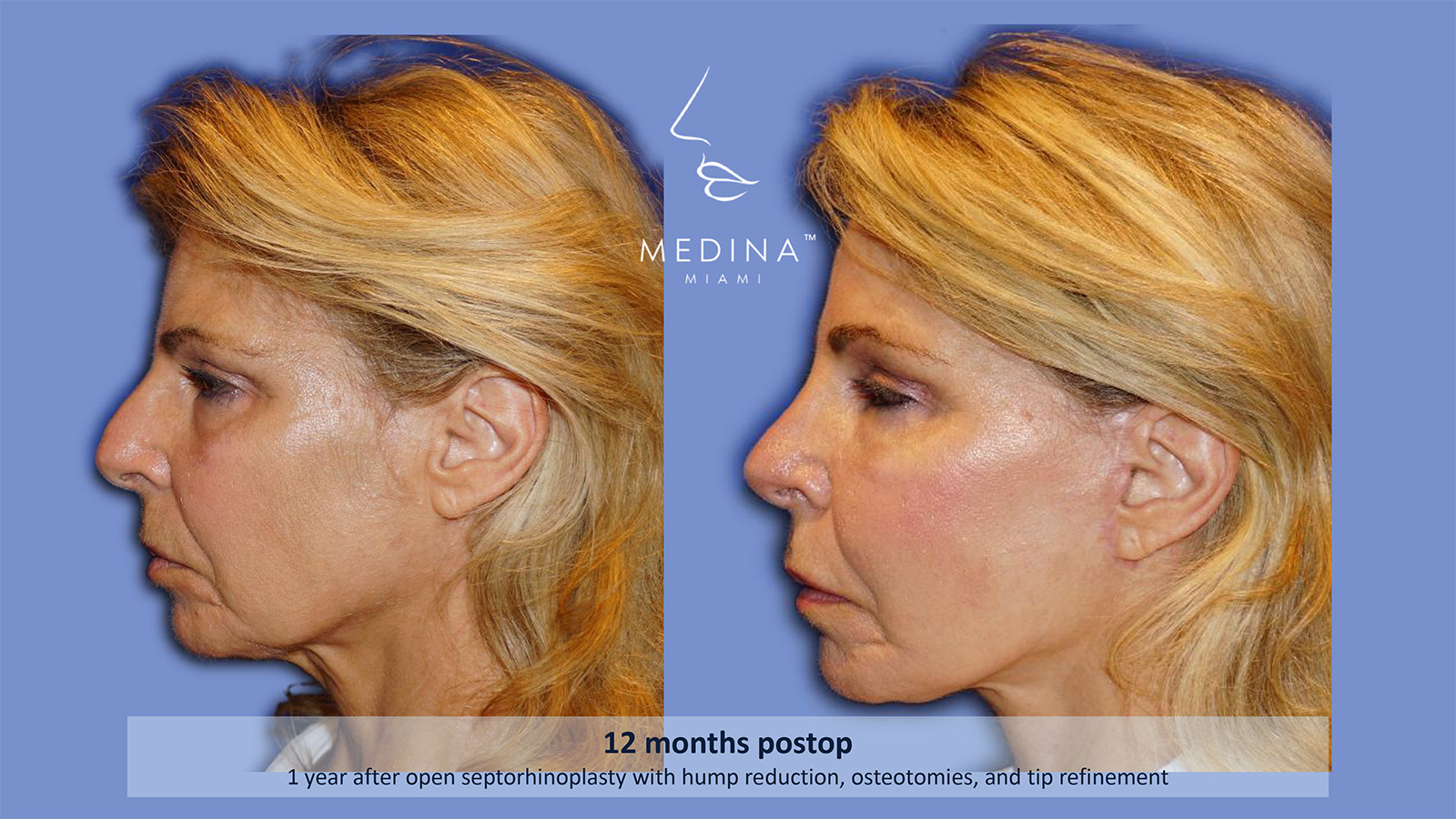 Case--4862 | Before and After Rhinoplasty 4