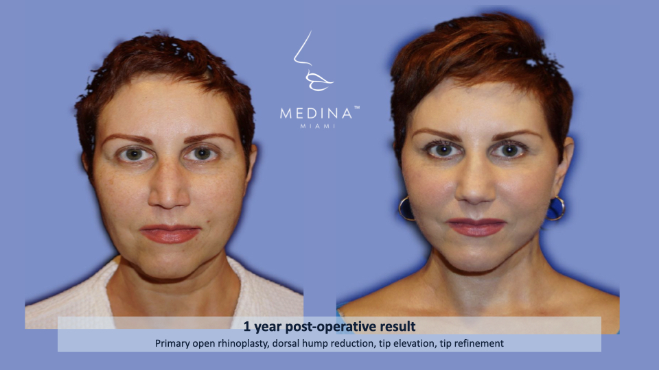 Case--8238 | Before and After Rhinoplasty