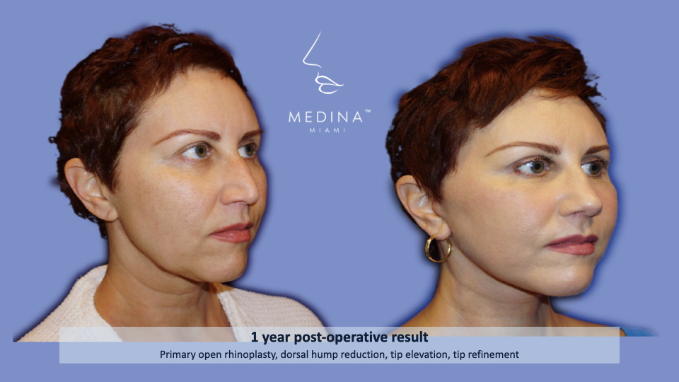 Case--8238 | Before and After Rhinoplasty 2