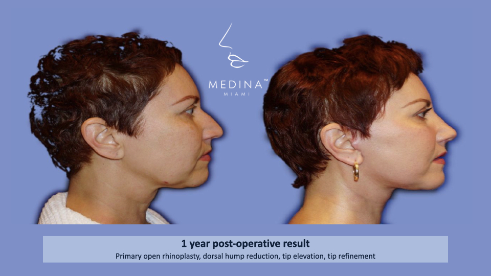 Case--8238 | Before and After Rhinoplasty 3