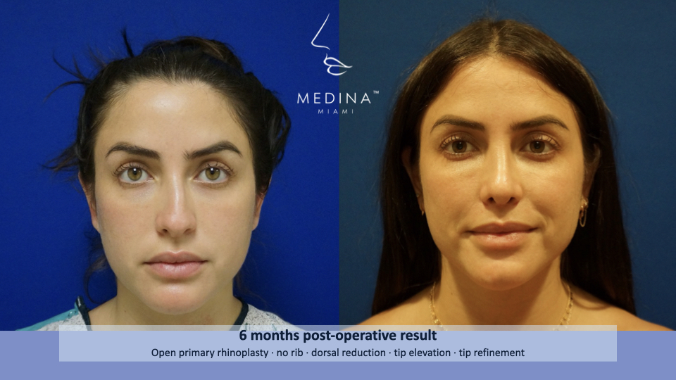 Case--4194 | Before and After Rhinoplasty