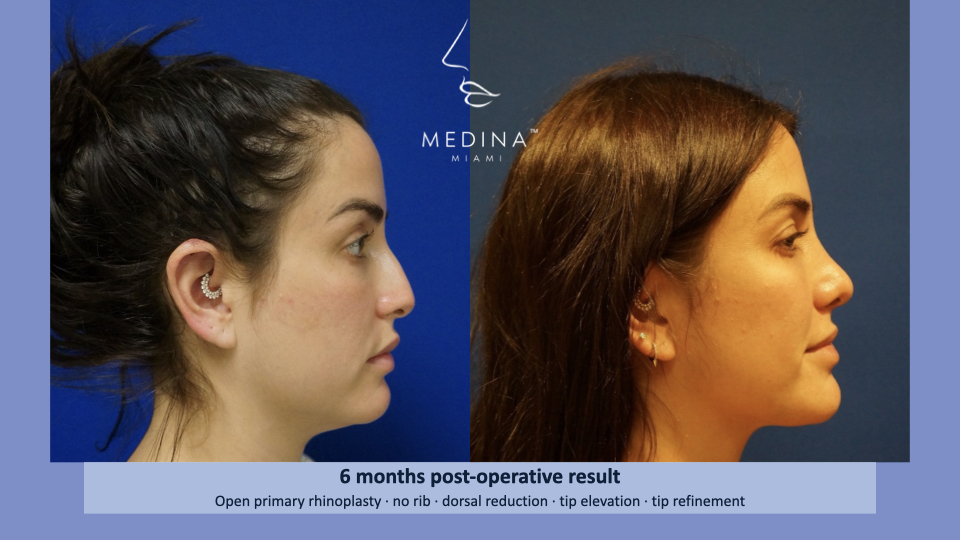 Case--4194 | Before and After Rhinoplasty 3