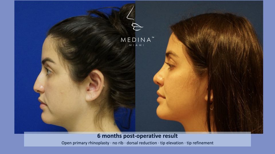 Case--4194 | Before and After Rhinoplasty 4