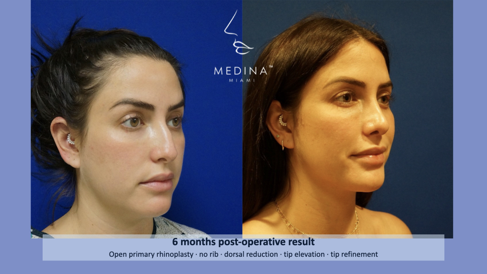 Case--4194 | Before and After Rhinoplasty 2