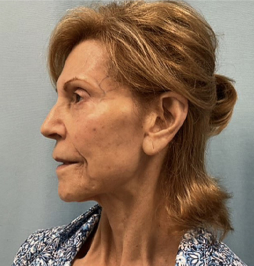Case--8267 | Before Facelift 9