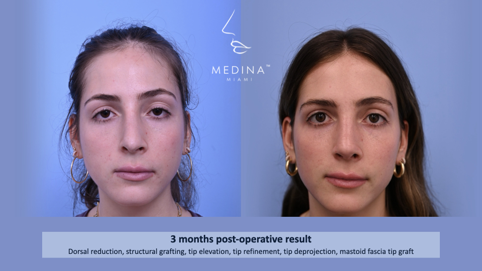 Case--2881 | Before and After Rhinoplasty