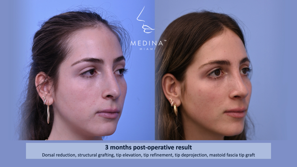 Case--2881 | Before and After Rhinoplasty 2