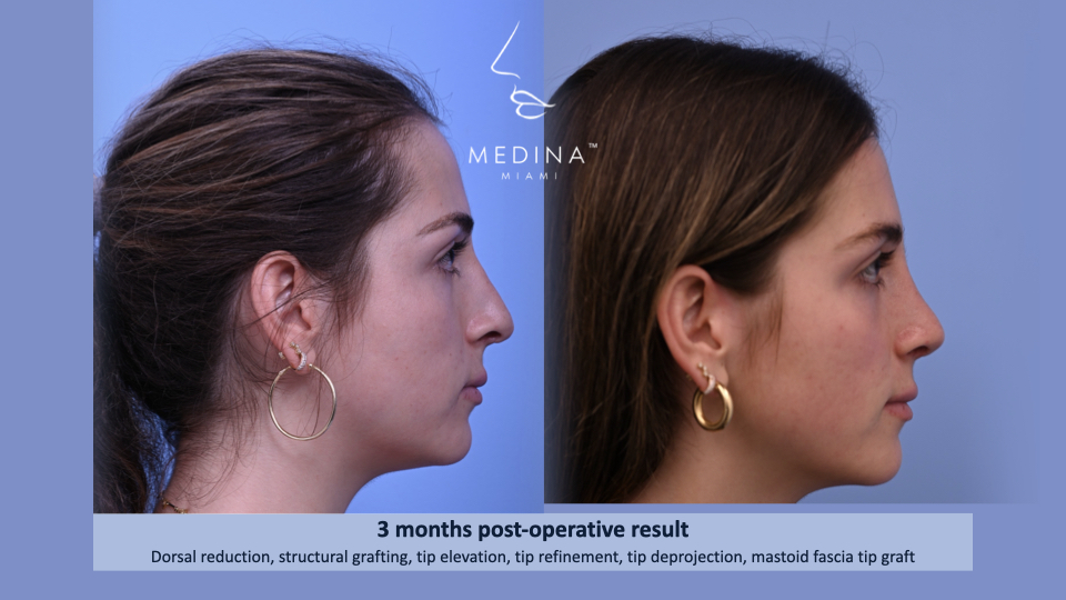 Case--2881 | Before and After Rhinoplasty 3