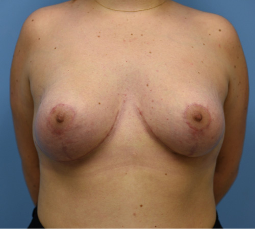 Case--9452 | After Breast Revision 6