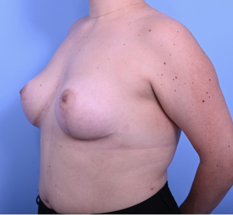 Case--9452 | After Breast Revision 2