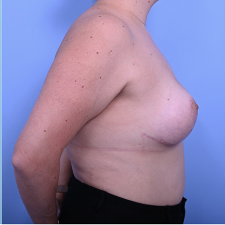 Case--9452 | After Breast Revision 5