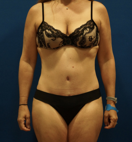 Case--2612 | After Tummy Tuck