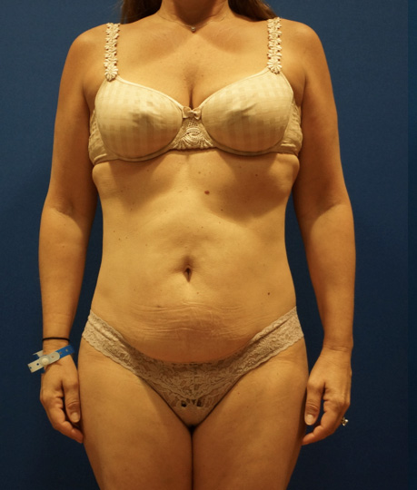 Case--2612 | Before Tummy Tuck