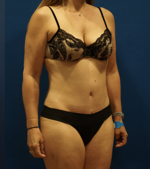Case--2612 | After Tummy Tuck 2