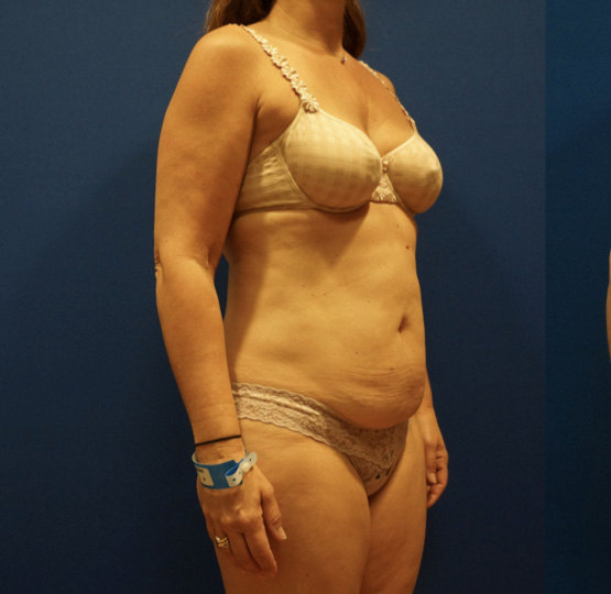 Case--2612 | Before Tummy Tuck 2