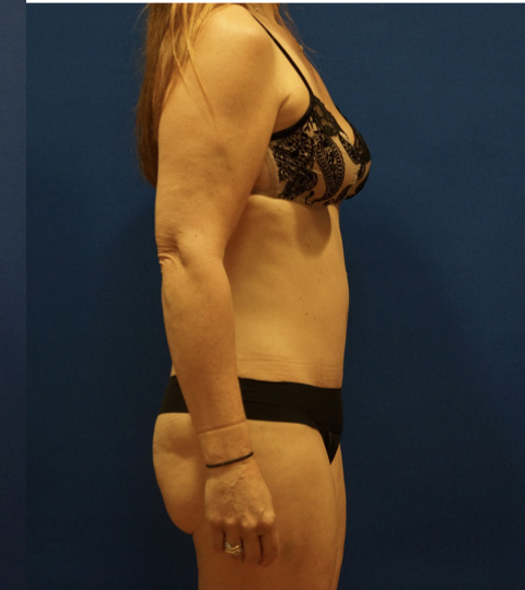 Case--2612 | After Tummy Tuck 3