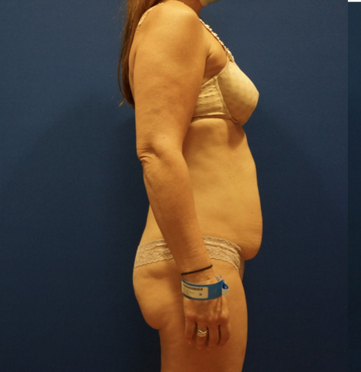 Case--2612 | Before Tummy Tuck 3