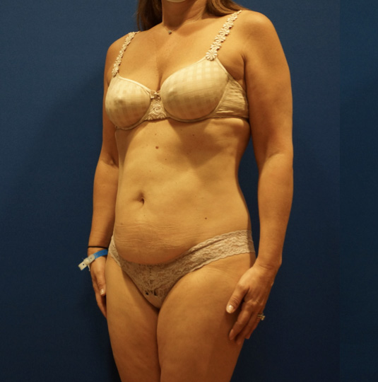 Case--2612 | Before Tummy Tuck 4