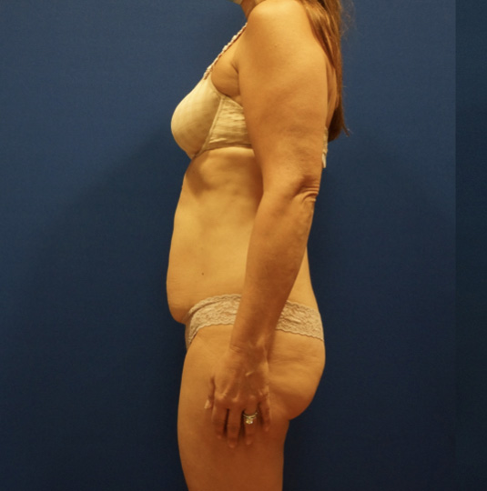 Case--2612 | Before Tummy Tuck 5
